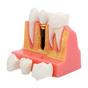 Powiększony model dziąsła z implantem